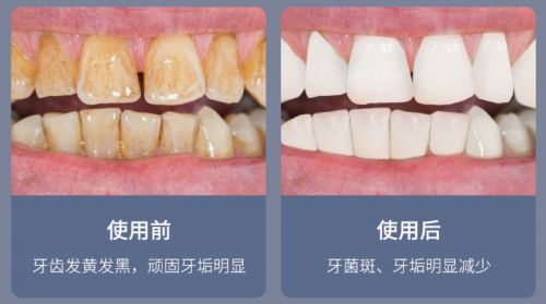 告别刷牙盲区，现代口腔护理新选择 为何它能解决你的深层困扰